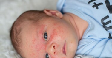 Baby mit einem Dermatitis im Gesicht