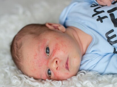 Baby mit einem Dermatitis im Gesicht