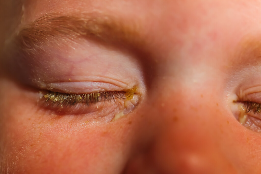  Augenentzündungen bei Kindern