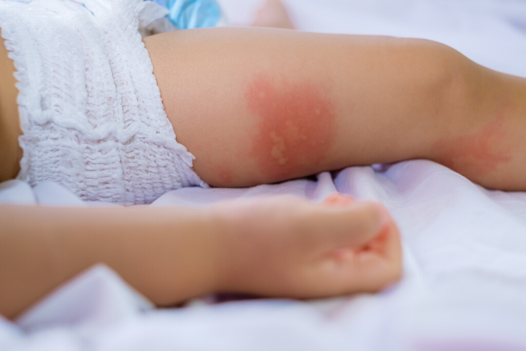 Dermatitis bei Babys