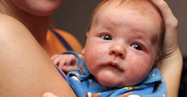 Baby mit Ausschlag durch Kuhmilcheiweißallergie