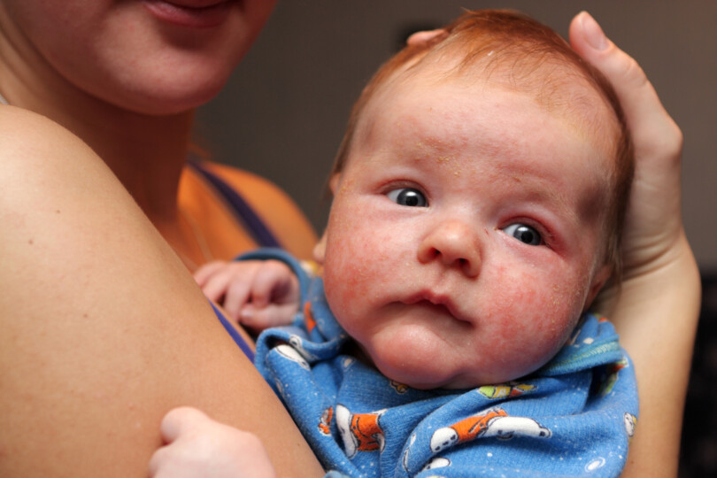 Baby mit Ausschlag durch Kuhmilcheiweißallergie