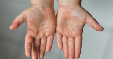 Hand-Fuß-Mund Krankheit - Bläschen auf den Händen