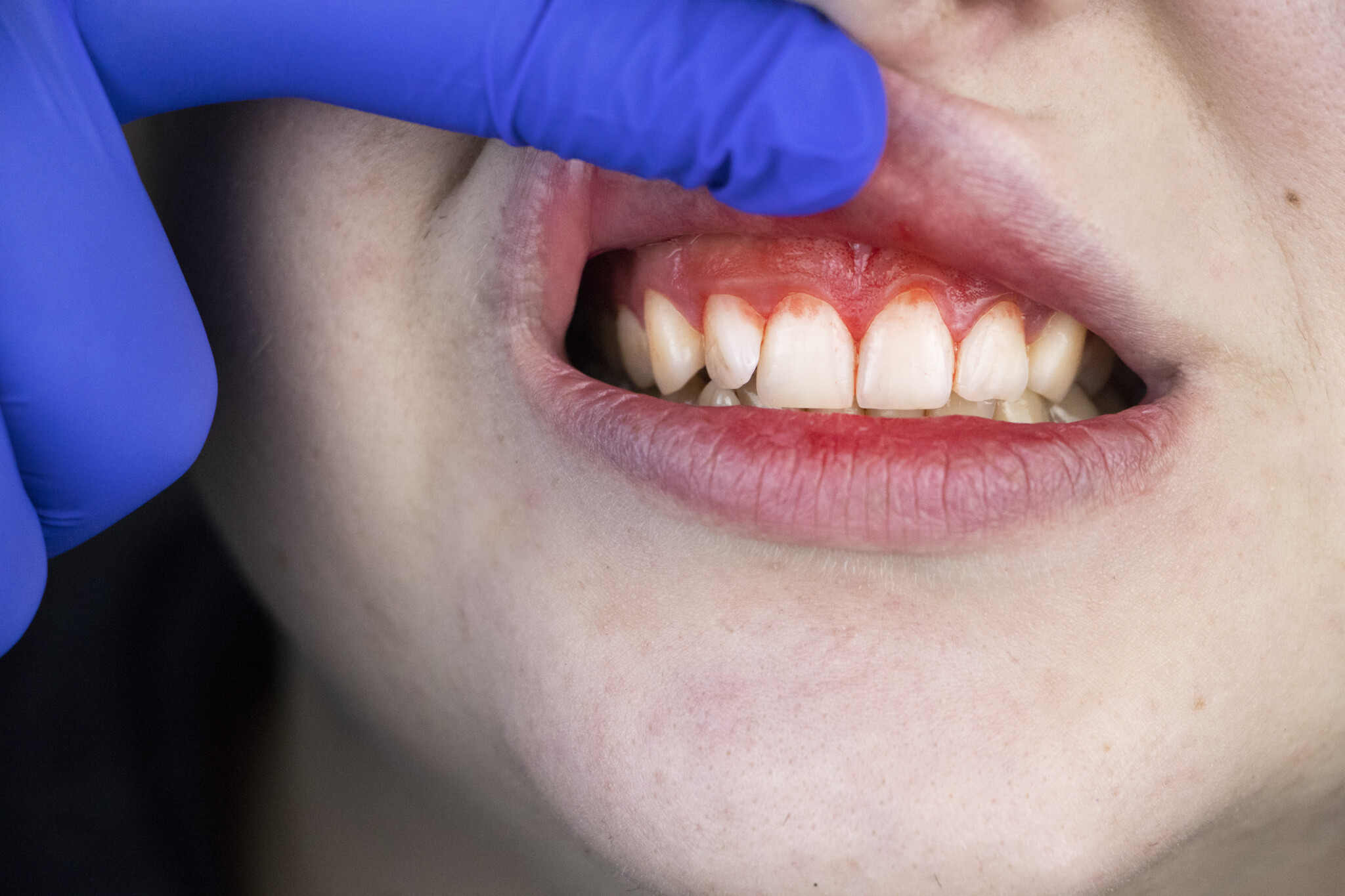 Zahnfleischentzündung Gingivitis erkennen und richtig behandeln