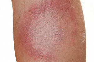 Borreliose: Bakterielle Infektion mit vielen Gesichtern