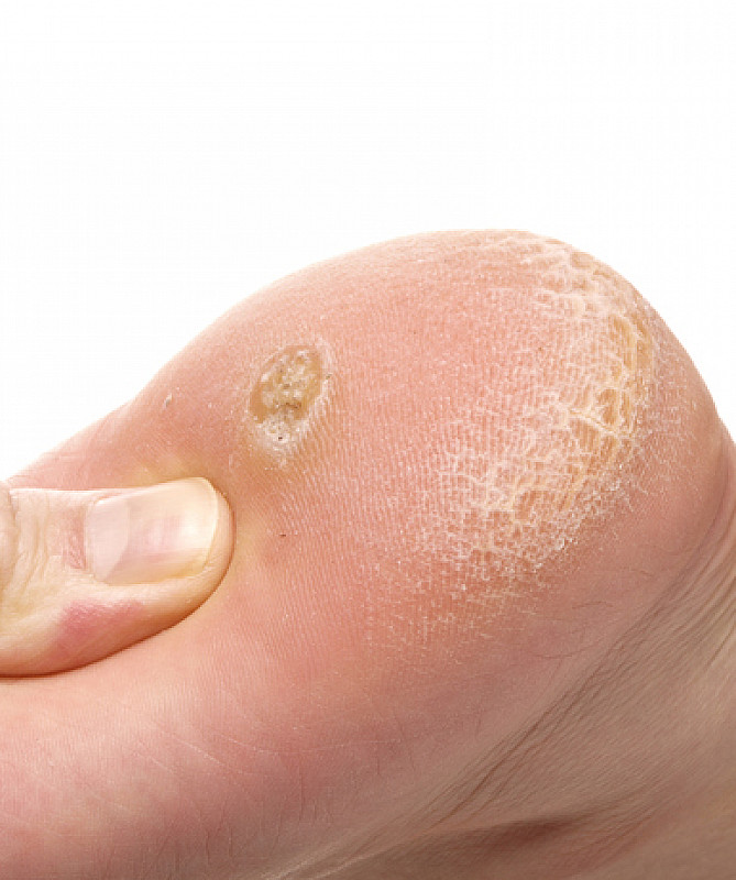 Fußpilz: Schnelle Lösung & Behandlung - medizinfuchs.de