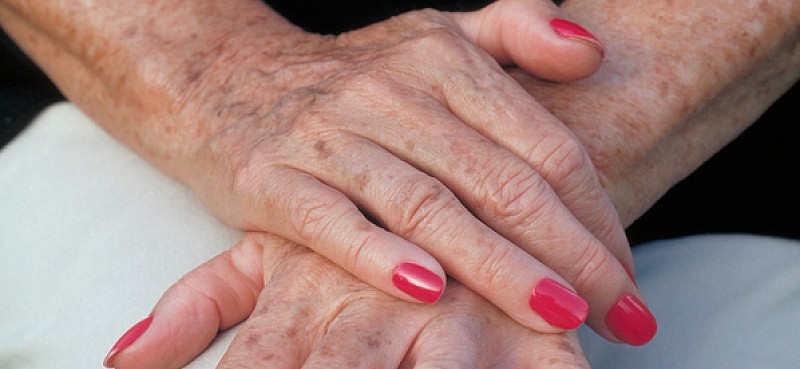 Altersflecken Entstehung &amp; Vorbeugen medizinfuchs.de