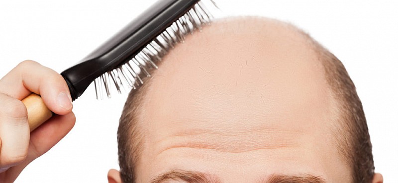 Haarausfall bei Männern – helfen Haarwuchsmittel wirklich?
