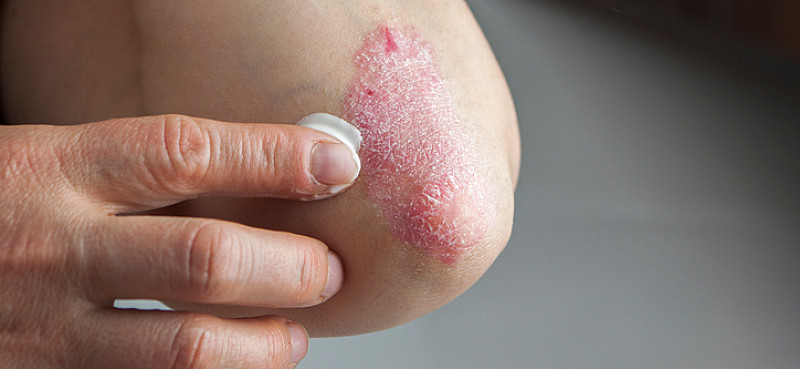 Schuppenflechte Die trockene Haut schmerzt medizinfuchs.de